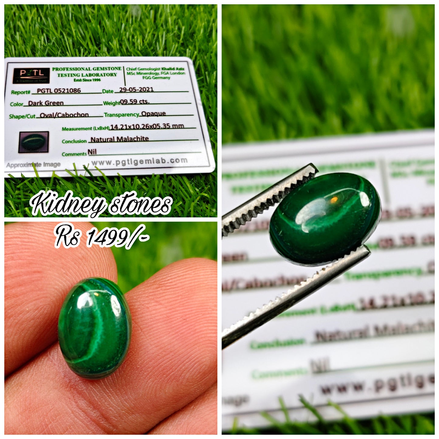 Kidney Stone With Lab certificate